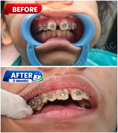 Braces Treatment