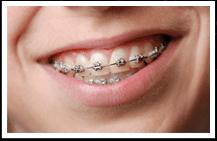 Metal braces