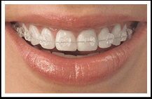 Ceramic Braces