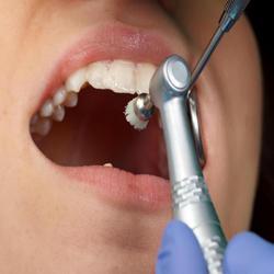 Fluoride Treatment