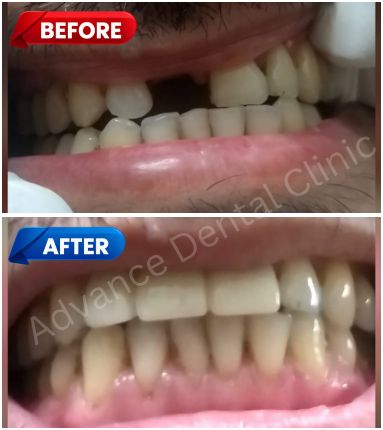 Full Ceramic Crown