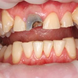 Gums Contouring