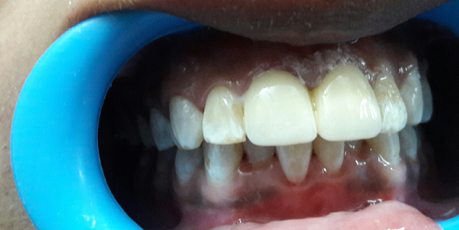 Braces in Mukherjee Nagar